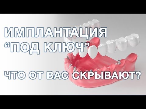 Имплантация зубов под ключ. Что это значит?