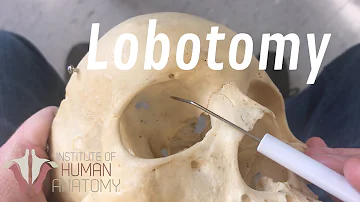 The Anatomy of a Lobotomy