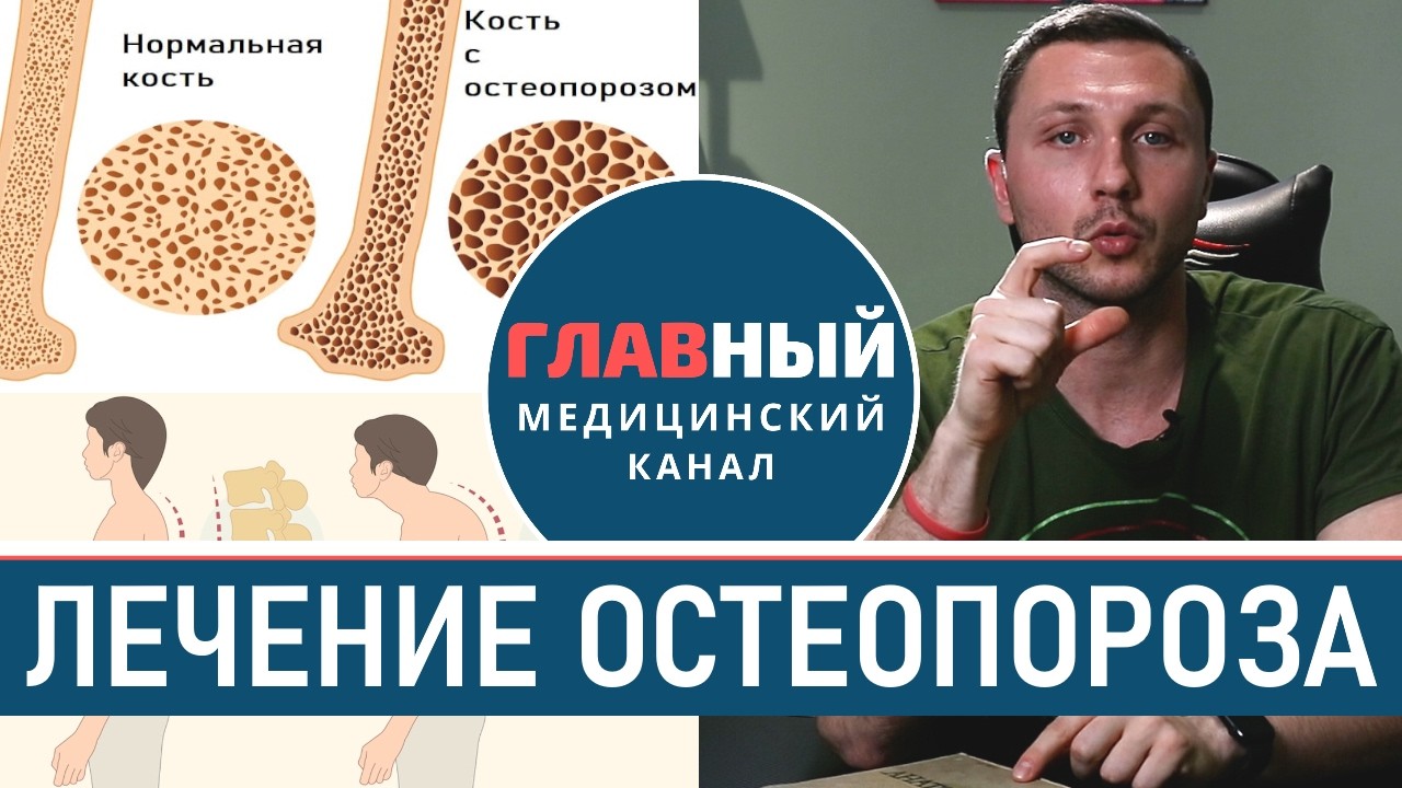 Как лечить ОСТЕОПОРОЗ костей. Лечение остеопороза у женщин и мужчин, профилактика