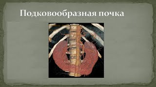 Подковообразная почка