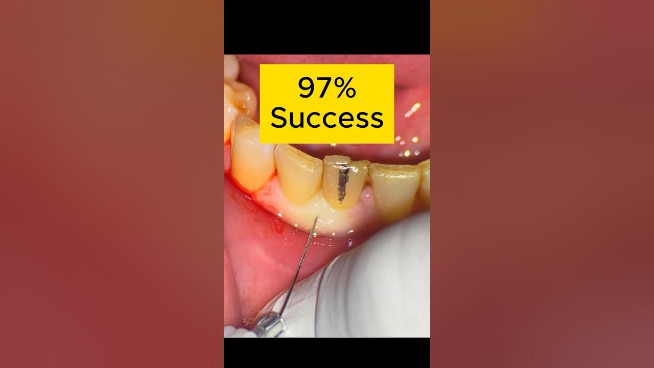How to easily NUMB lower anterior teeth. YouTube