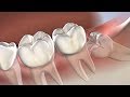 Wisdom Teeth Removal in Dallas TX | Park Cities Oral & Maxillofacial Surgery Associates