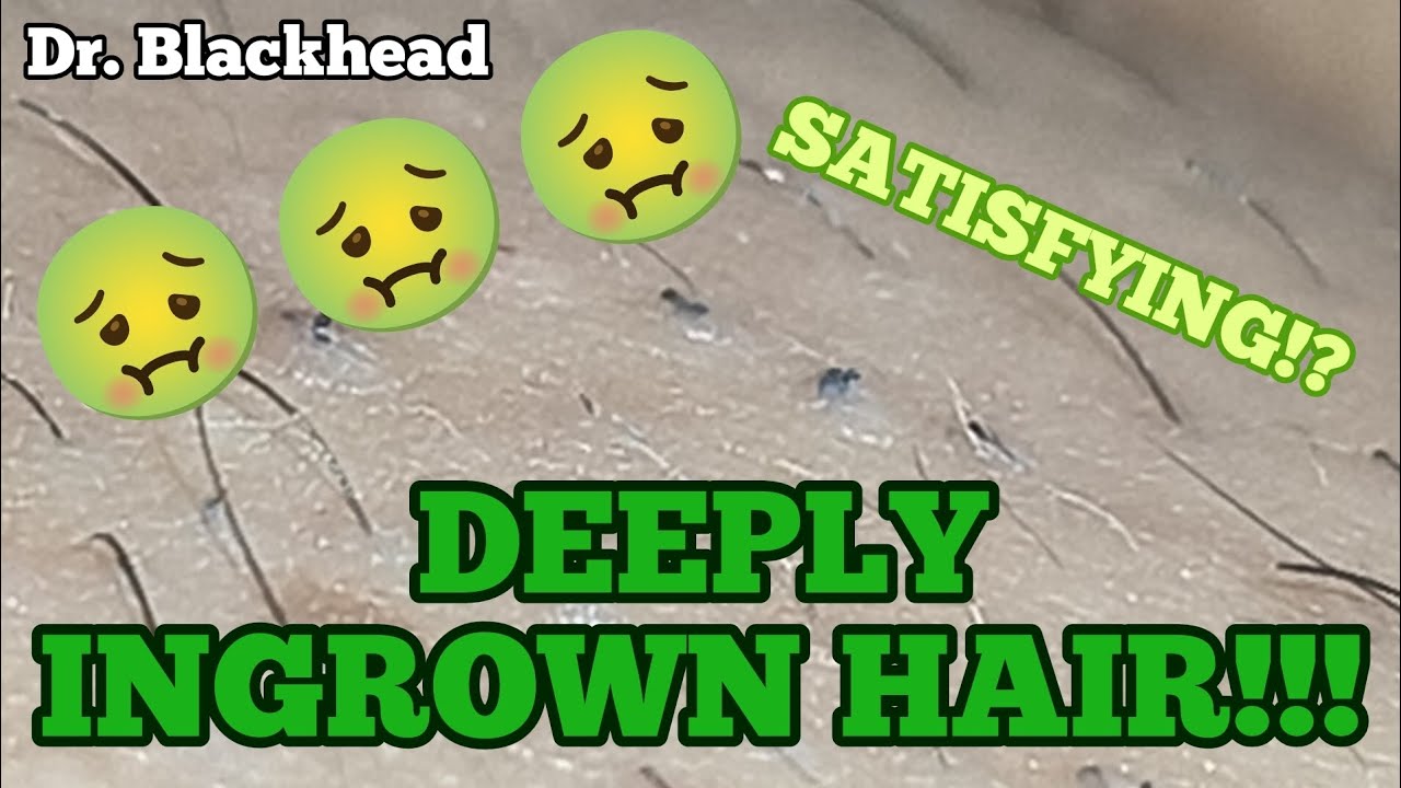 **JUICY** SATISFYING INGROWN HAIR REMOVAL😍😍😍 YouTube