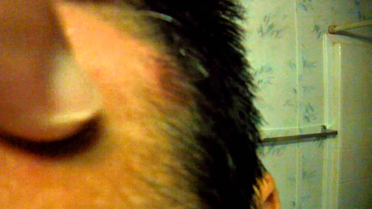 Acne, Boils try Bragg Apple Cider Vinegar it worked for me - YouTube