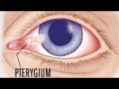 Video: Pterygium: Orsaker, Symtom Och Diagnos