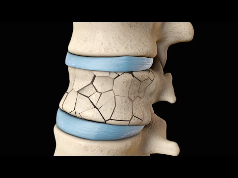 Back Surgery | Vertebroplasty and Kyphoplasty | Nucleus Health