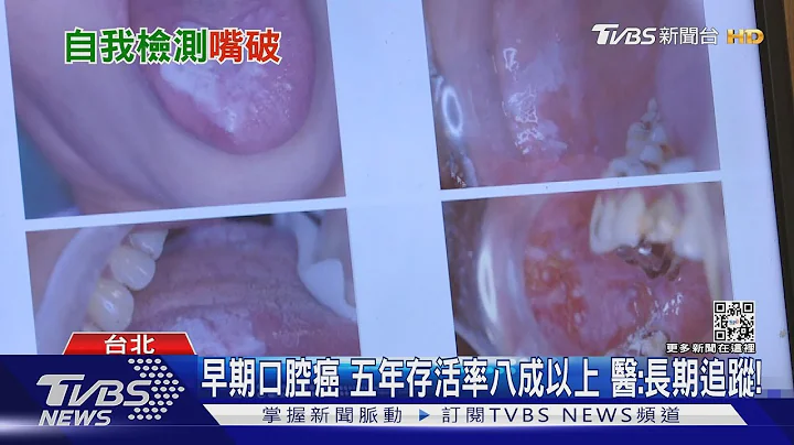 輕忽「嘴破」這幾種症狀...醫:罹「口腔癌」機率增 速就醫!｜十點不一樣20221115 - 天天要聞