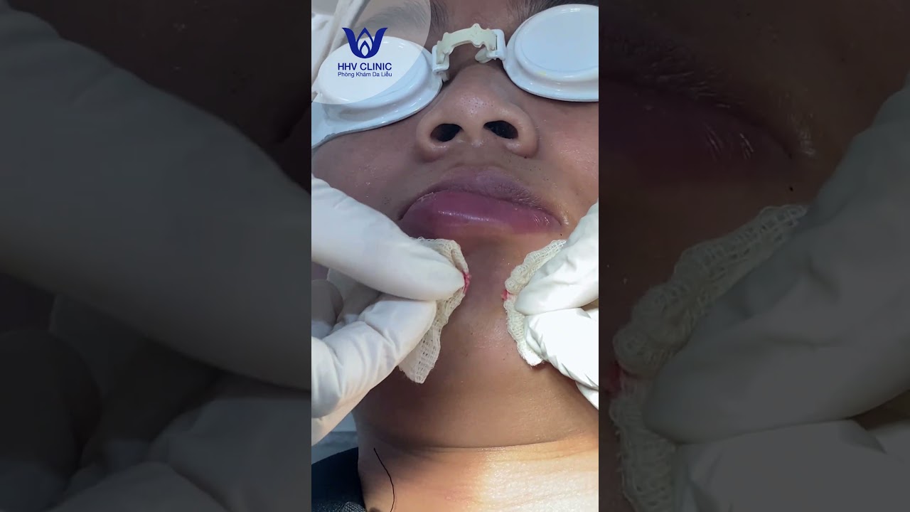 Nặn mụn nhọt vùng cằm.