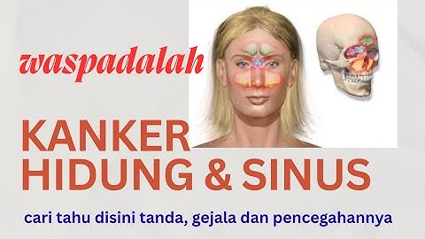 Ketahui dan Antisipasi Bahaya Kanker Hidung-Sinus atau Kanker Sinonasal, simak tuntas disini...