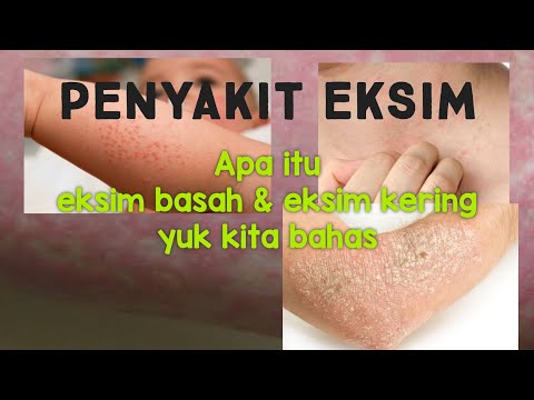 Video: Dermatitis - Penyebab, Gejala Dermatitis, Diet. Dermatitis Kering, Gatal, Berjangkit, Telinga Dan Makanan