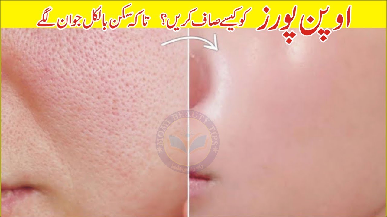 Remove Open Pores Blackhead Whitehead Naturally in 5 Days💕 DIY Face Scrub/Toner 