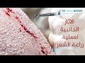 أضرار زراعة الشعر - دكتور يتكين باير   |  Dr. Bayer Clinics