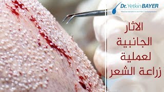 أضرار زراعة الشعر - دكتور يتكين باير   |  Dr. Bayer Clinics