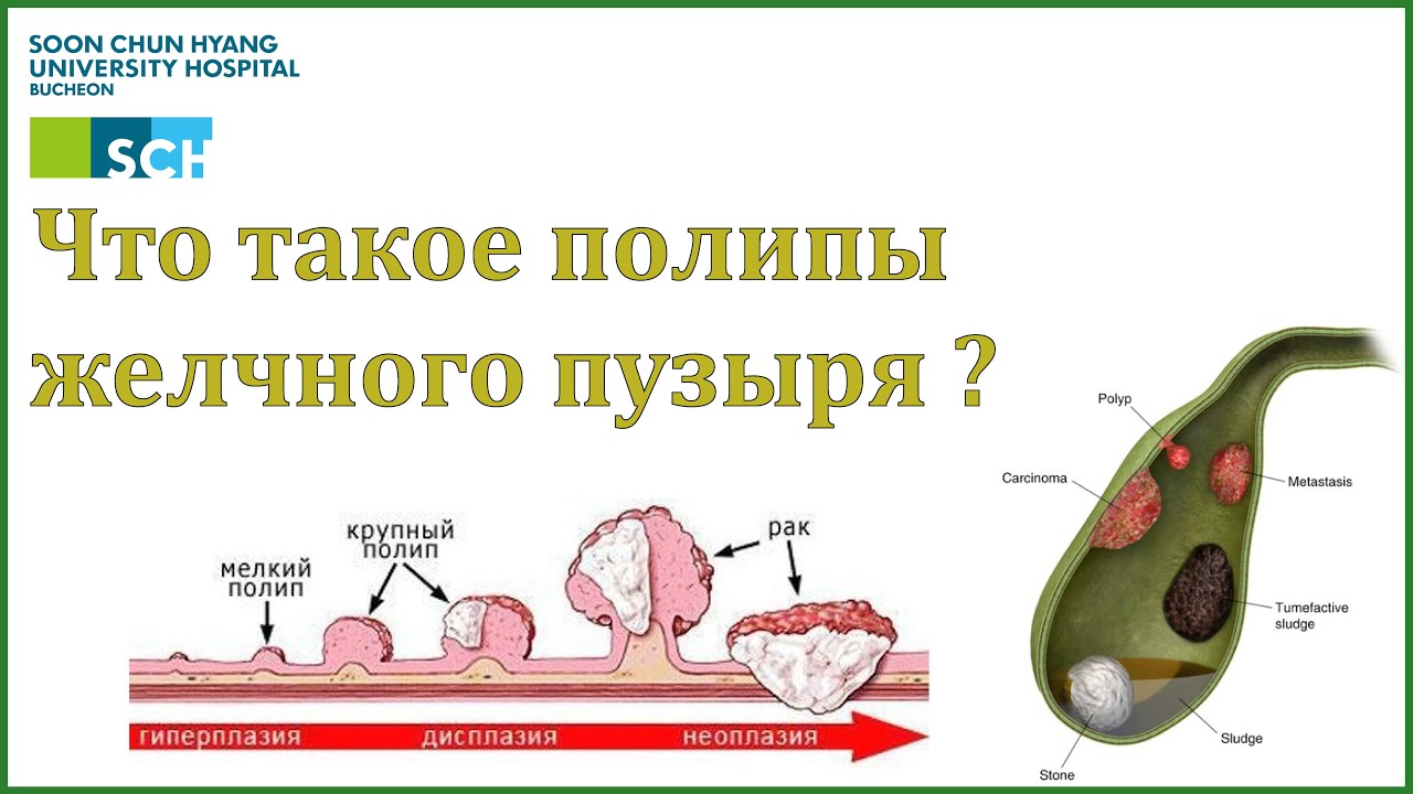 Признаки полипа желчного пузыря. Полипы желчного пузыря классификация. Холестериновые полипы в желчном. Как выглядит полип в желчном пузыре.