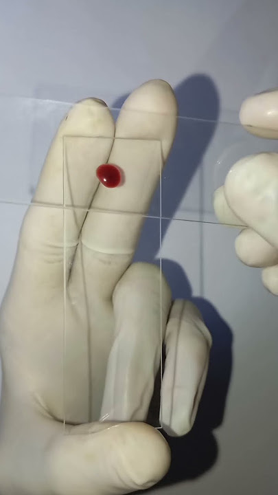 peripheral blood smear🩸
