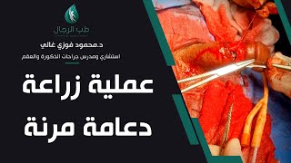 عملية زراعة دعامة مرنة  / دكتور محمود فوزي غالي