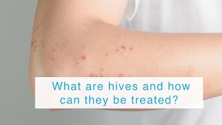 What are hives and how can they be treated?