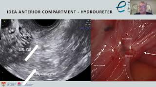 A/Prof George Condous on Endometriosis Ultrasound at the World Congress on Endometriosis (WCE) 2021 screenshot 1