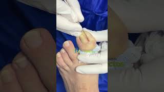 Matricectomia mal realizada ‼️ #satisfying #ingrown_toenail_surgery #onicocriptosis
