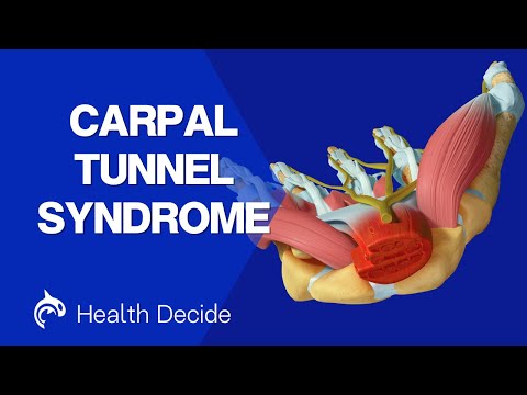Videó: Hogyan kezeljük a carpalis alagút szindrómát: 12 lépés (képekkel)