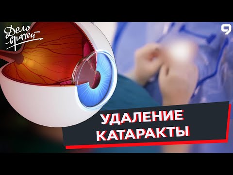 Программа "Дело врачей". Операция по удалению катаракты. Имплантация хрусталика глаза. Астигматизм.