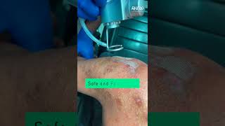 LASER  TREATMENT FOR KELOID