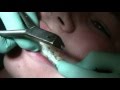 Watch how we take your braces off!
