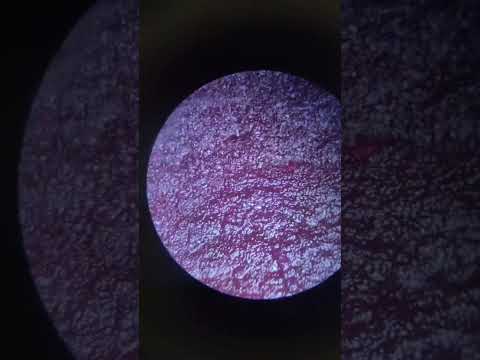 علاح السرطان الشمندر البنجر الاحمر فوائد طبية للسرطان