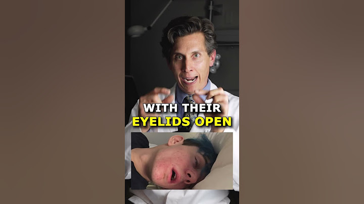 Yes, you CAN sleep with your eyes OPEN 👀#eyehealth #eyedoctor
