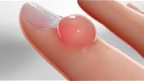 CPT code for Excision of cyst - simplify medical coding