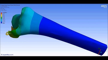 ANSYS WB Static Structural FEA - Simulation of the treatment of a tibial plateau fracture