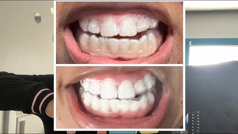 Byte ALIGNERS: STUCK ON 15?!?! | Ben and Cin