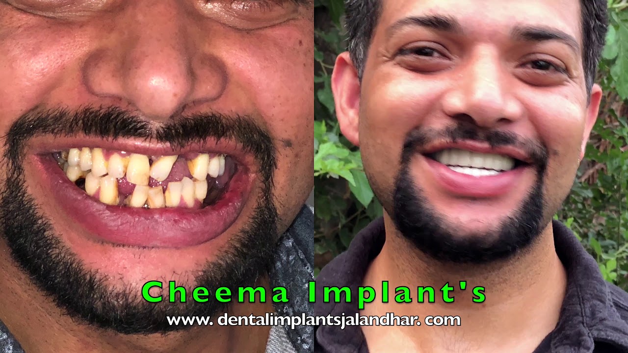 All 4 full dental implants extraction procedure cost nobel biocare