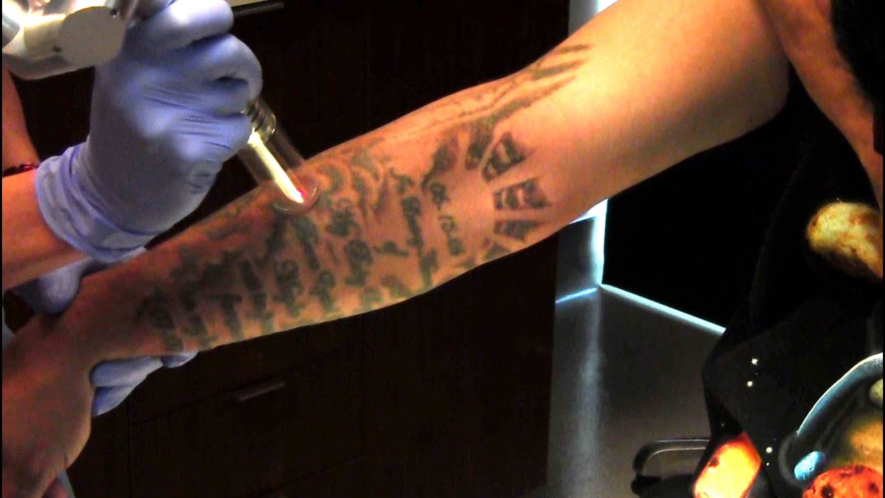 100+ [ Tattoo Removal Salary ] | Invisible Ink Tattoo ...