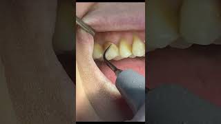 ПРОФЕССИОНАЛЬНАЯ ЧИСТКА ЗУБОВ 💎 #стоматология#видео #dentist #протезирование #керамика