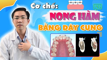 Cơ Chế Nong Hàm Bằng Dây Cung Khi Niềng Răng