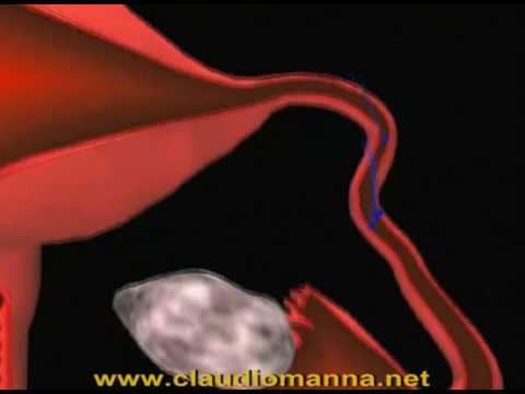 Video: Le tube di Falloppio possono spostarsi tra le ovaie?