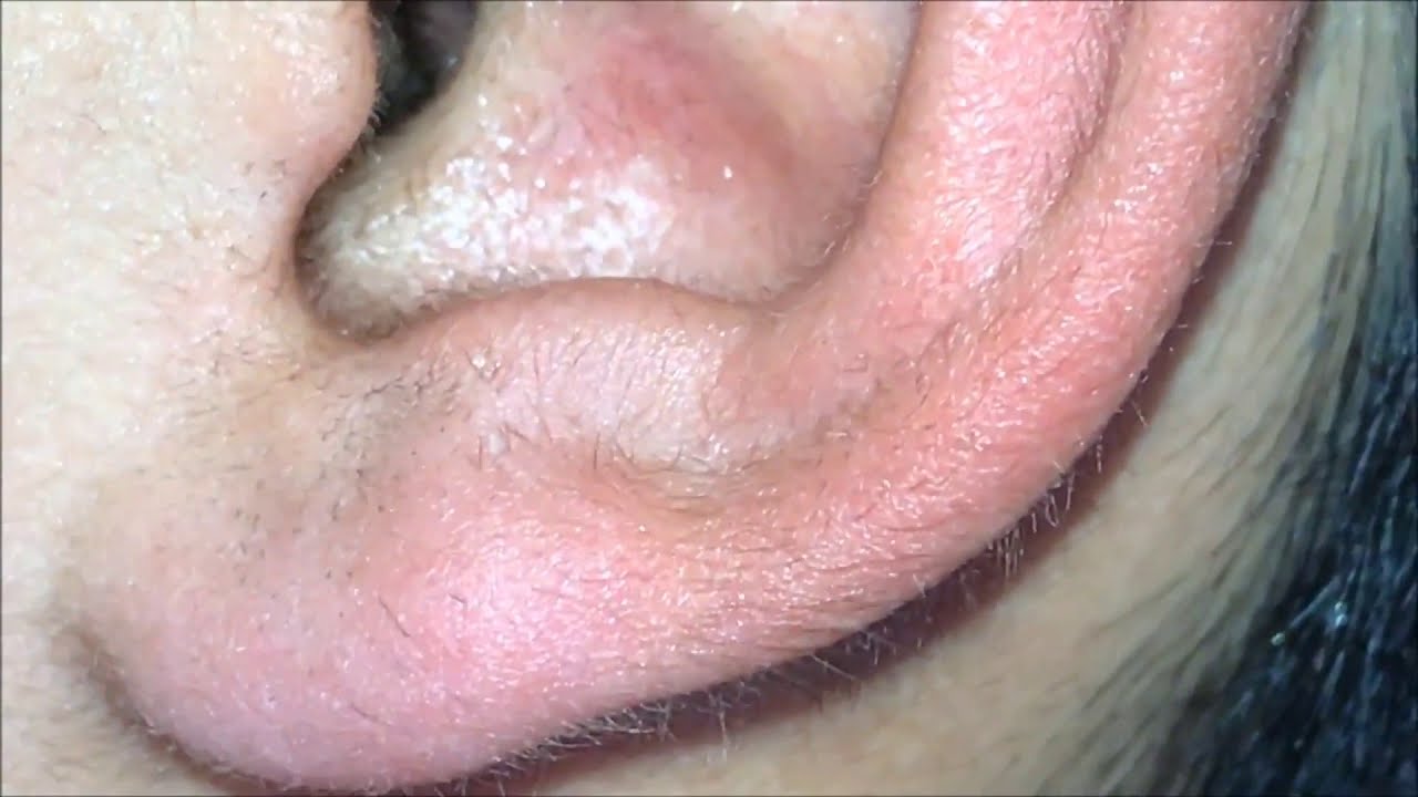 satisfying video,Ear wax removal,blackheads Extraction in Ear part 23
