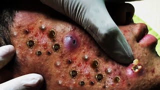 Make Your day Relaxing with Whiteheads Removal Pimple Popping New Videos