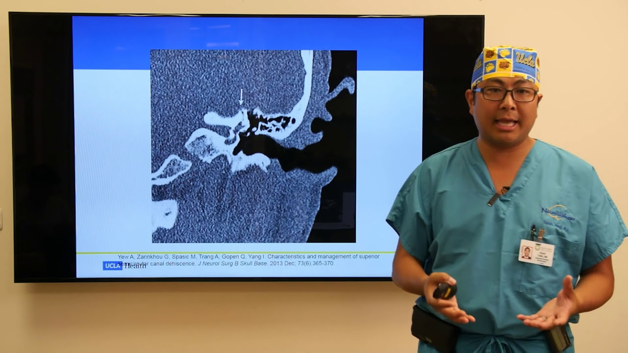 Minimally Invasive Surgery for Superior Semicircular Canal Dehiscence | UCLAMDChat