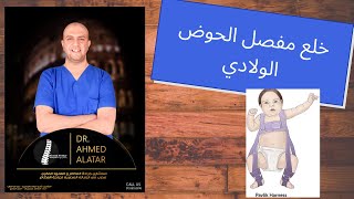 خلع الورك الولادي المتطور للدكتور احمد العطار
