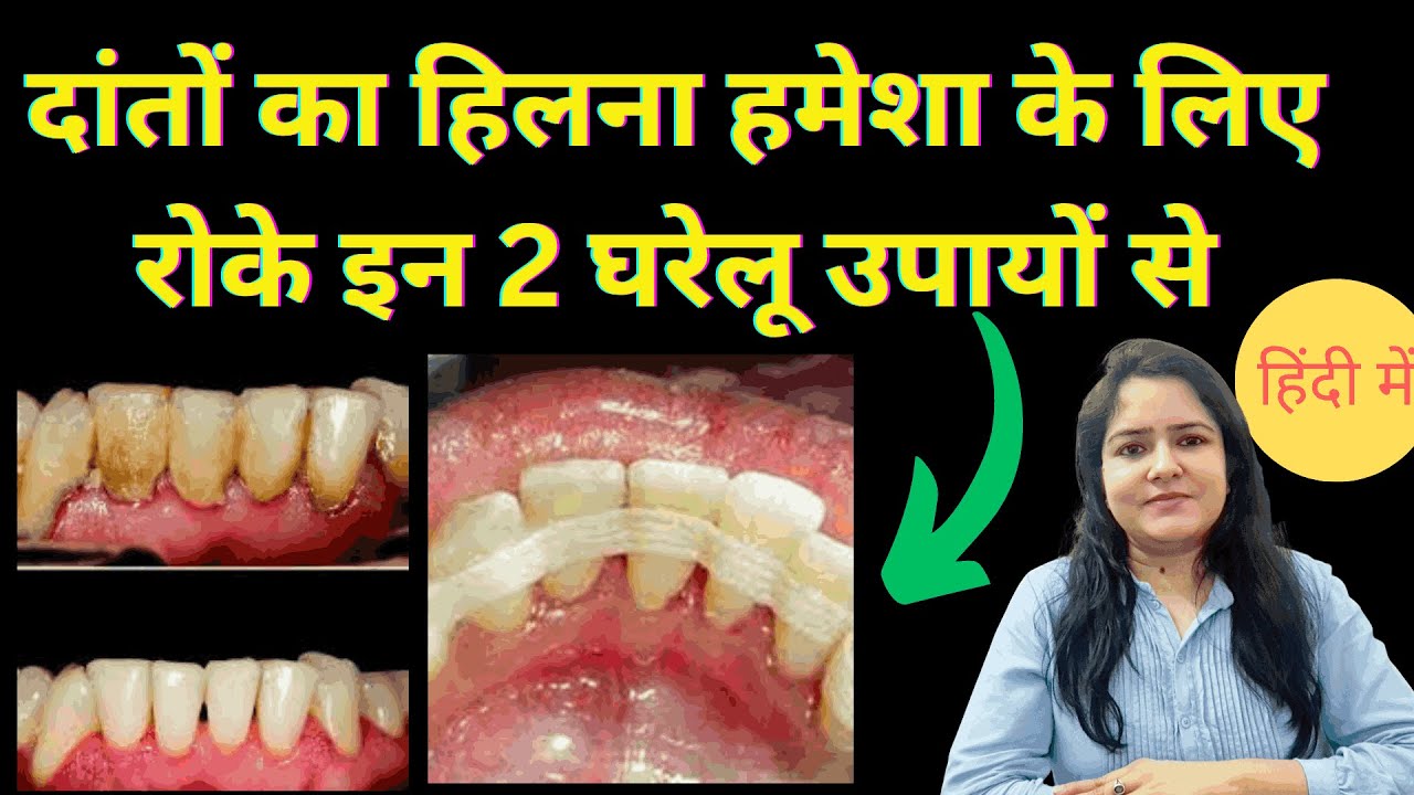  दांतों का हिलना घर पर ही ठीक कैसे करे। hilte danto ko gar par theek kaise kare?? #dentist #trending
