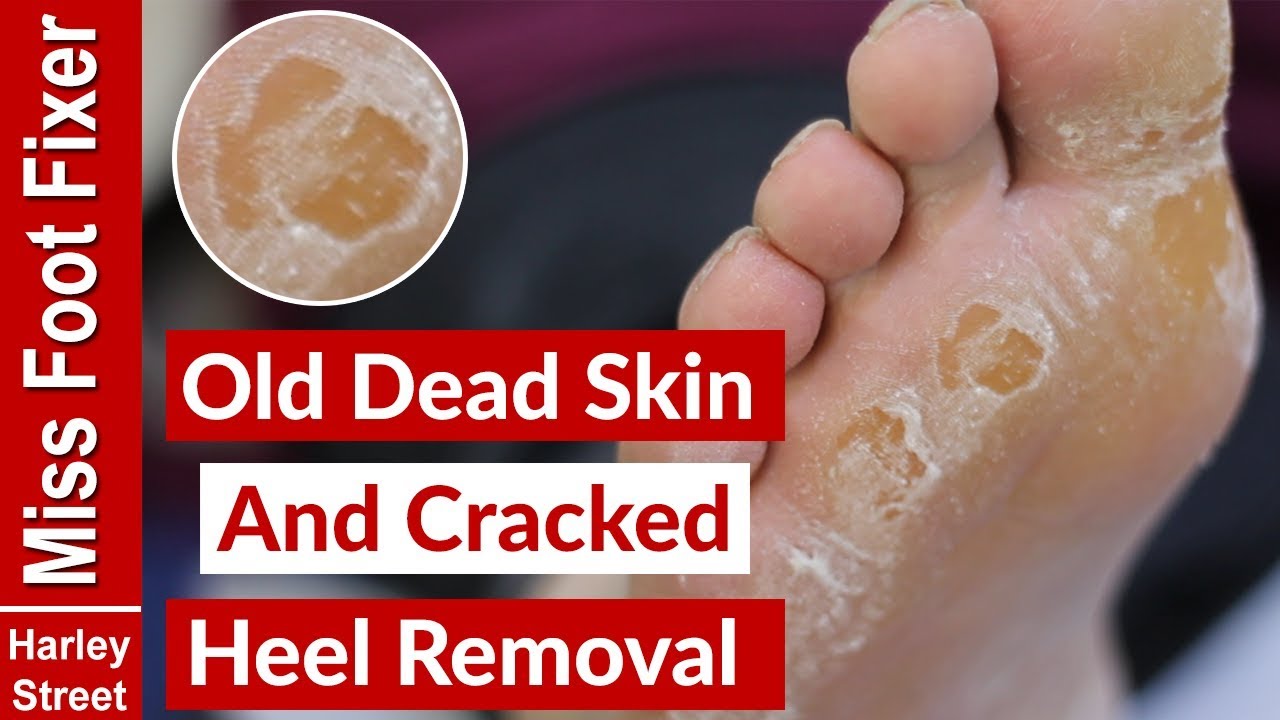 OLD DRY SKIN AND CRACKED HEEL REMOVAL BY MISS FOOT FIXER YouTube
