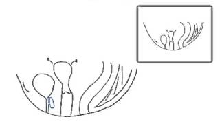 Divertikelexstirpation