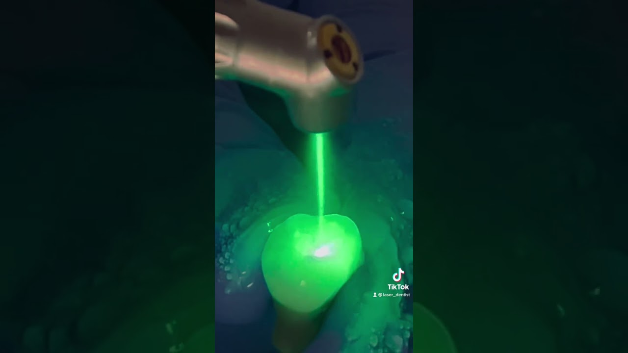 Needle and numbness free fillings with CO2 laser #dentist #filling #tooth #laser #solea