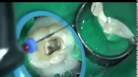 Cold hydraulic compaction technique using bioceramic cement and GP