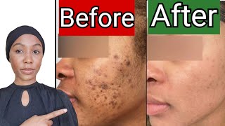 How to fade Stubborn Spots & hyperpigmentation (with just 1 product)