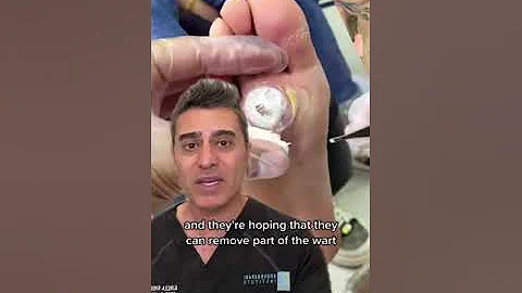 " Huge Wart " on Foot...