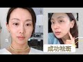 【Ann阿姨 医美分享】淡斑2个多月更新：我的老年斑去掉了 | 毫无准备又来了一次激光