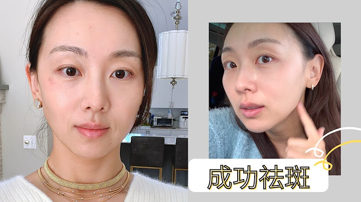 【Ann阿姨 醫美分享】淡斑2個多月更新：我的老年斑去掉了 | 毫無準備又來了一次激光 - 天天要聞